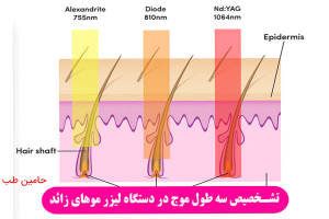 تشخیص سه طول موج الکس، دایود و‌اندیاگ در دستگاه لیزر مو‌های زاید